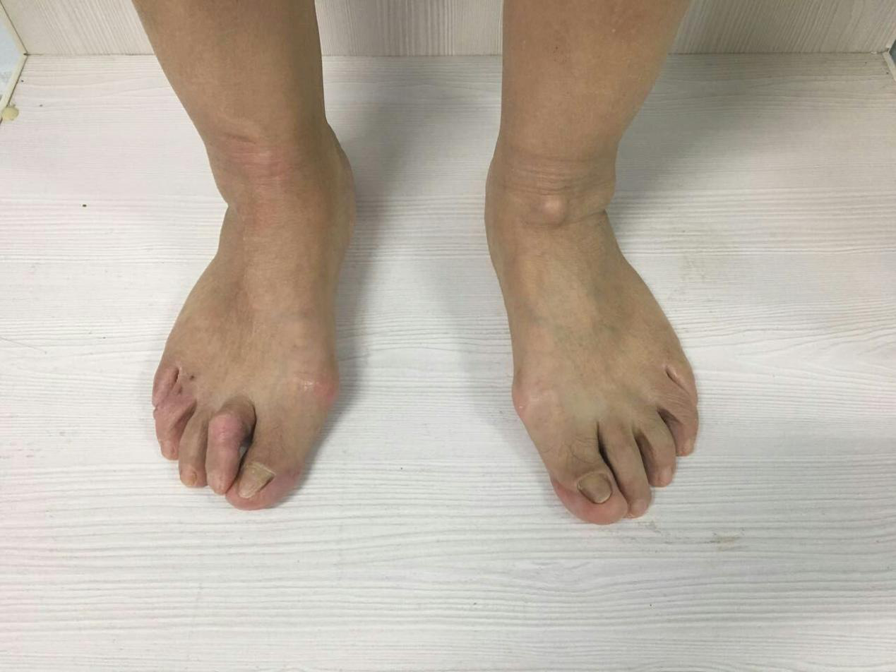 拇外翻病例介绍 - 好大夫在线