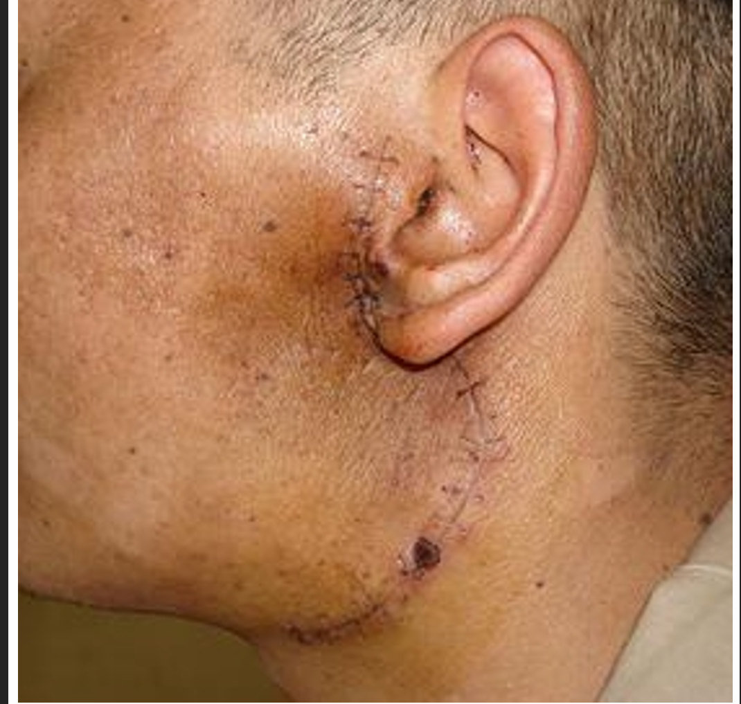 近千名甲状腺 腮腺肿瘤患者是否做了 假的 手术