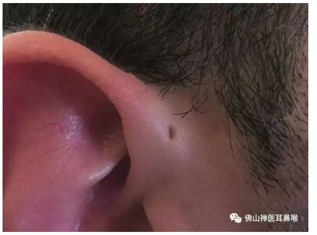 你的耳朵上有小洞吗? - 好大夫在线