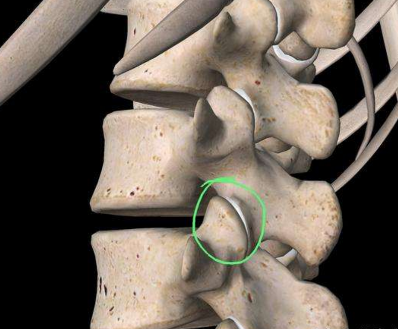 容易被忽视的腰痛原因腰椎关节突源性腰痛