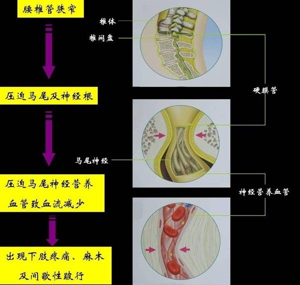 对腰椎管狭窄症的间歇性跛行症状出现的机制认识