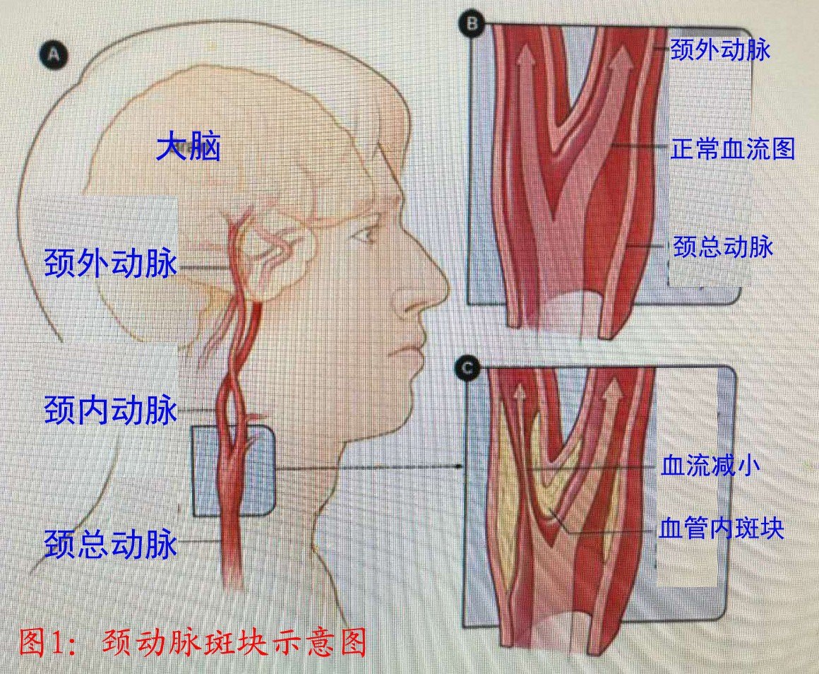 颈动脉窦位置真人图片图片