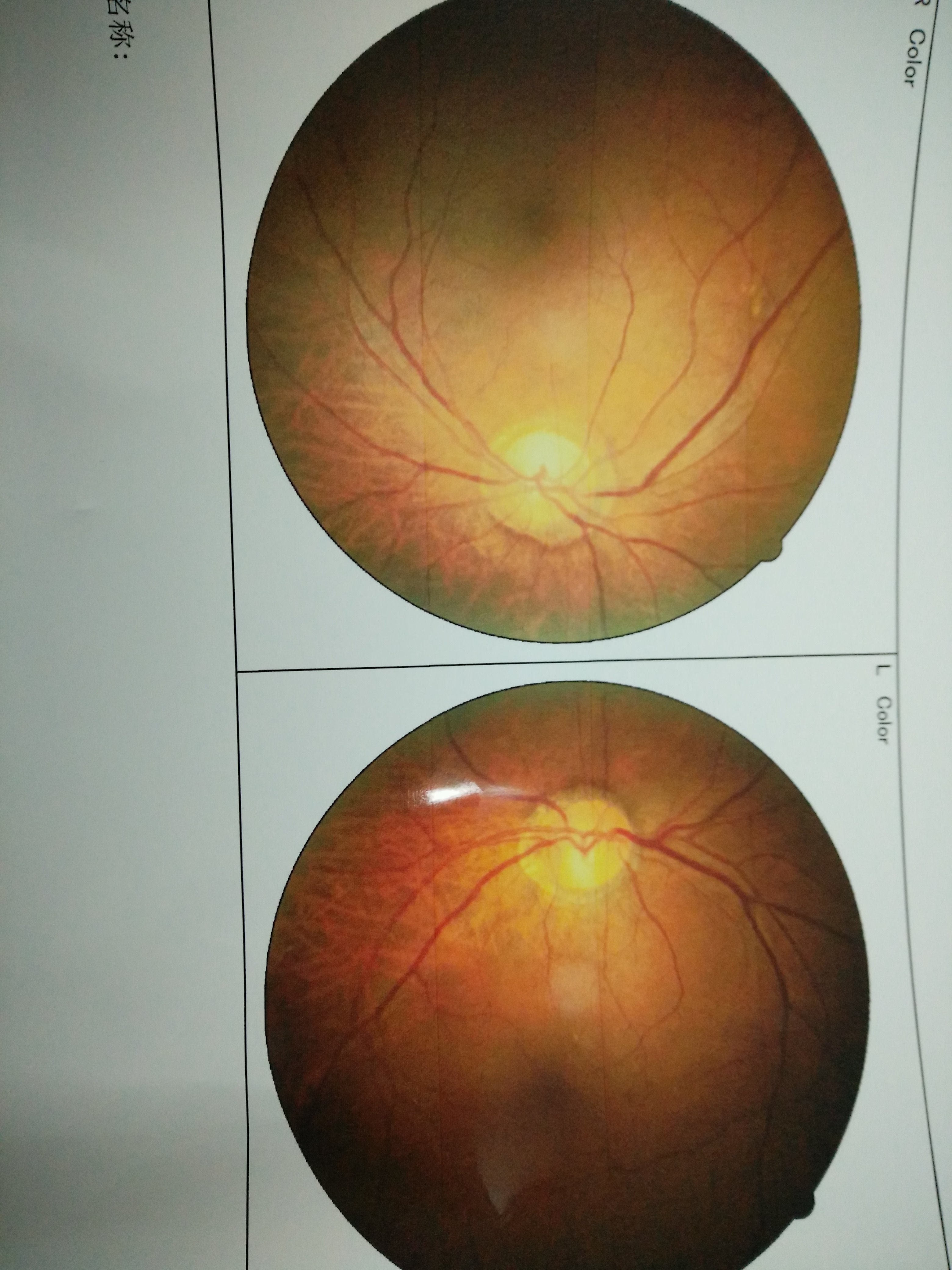 服用抗结核药物导致的中毒性视神经萎缩 