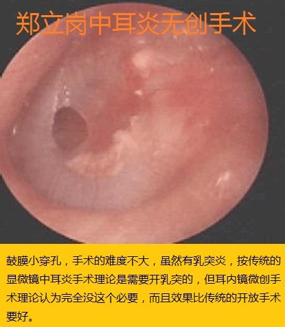 慢性中耳乳突炎耳内镜无创手术第426湖南邵阳