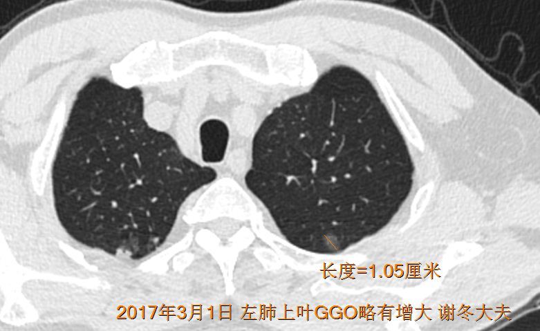 病例10 左肺上葉ggo緩慢生長,2010隨訪至2017年,從0.7長到1.