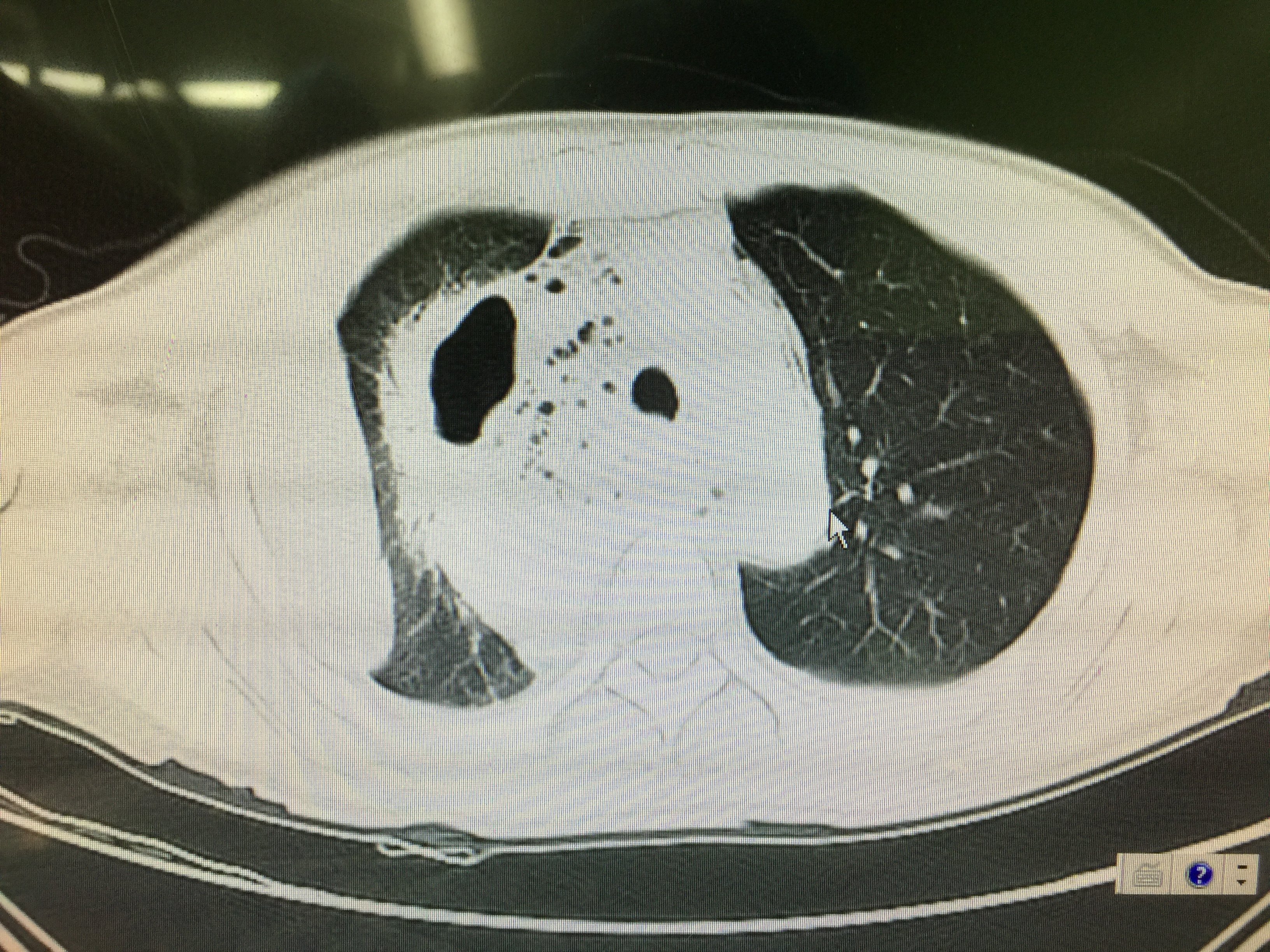 凶险的纵隔感染 - 好大夫在线
