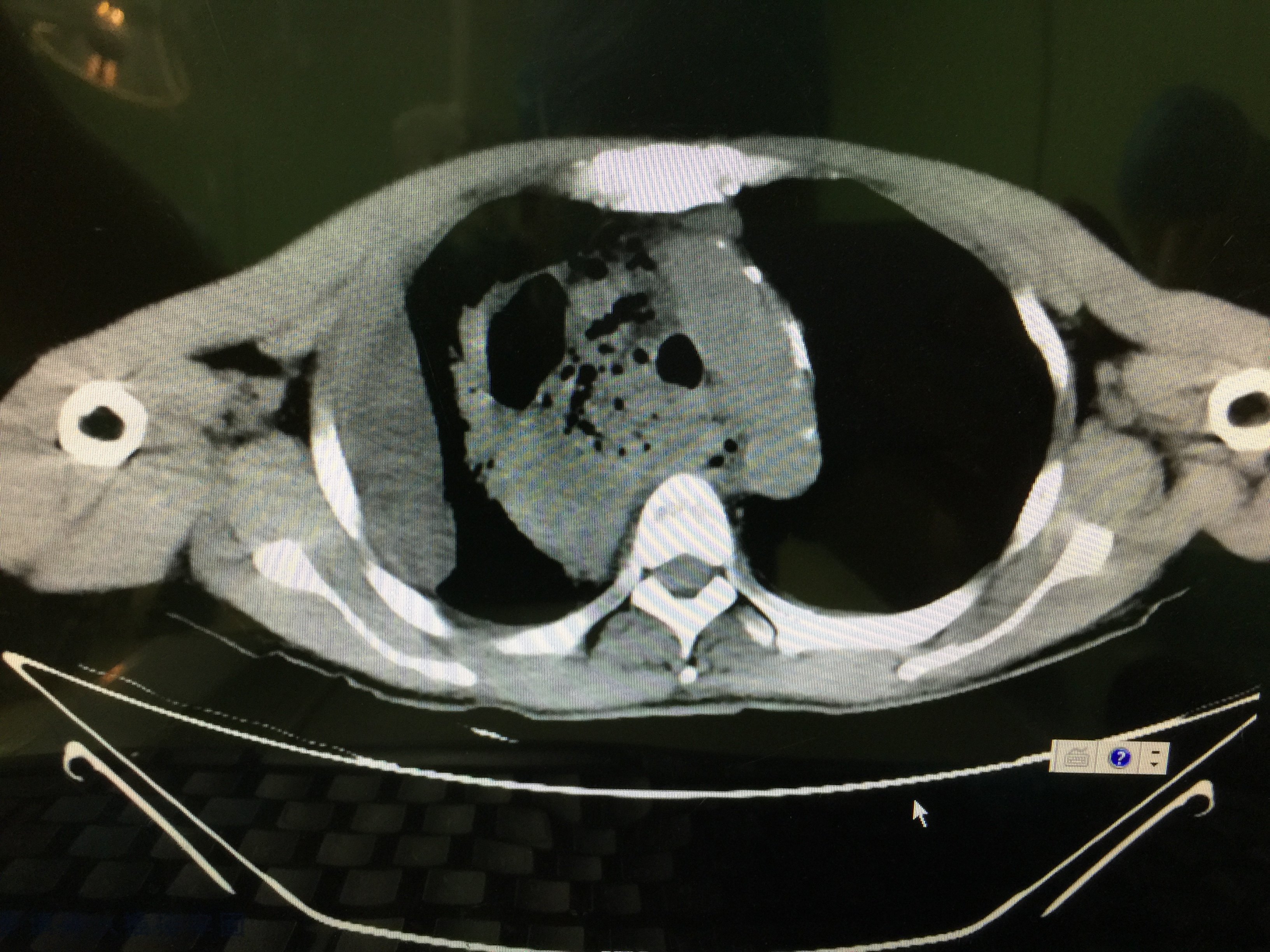 凶险的纵隔感染 - 好大夫在线