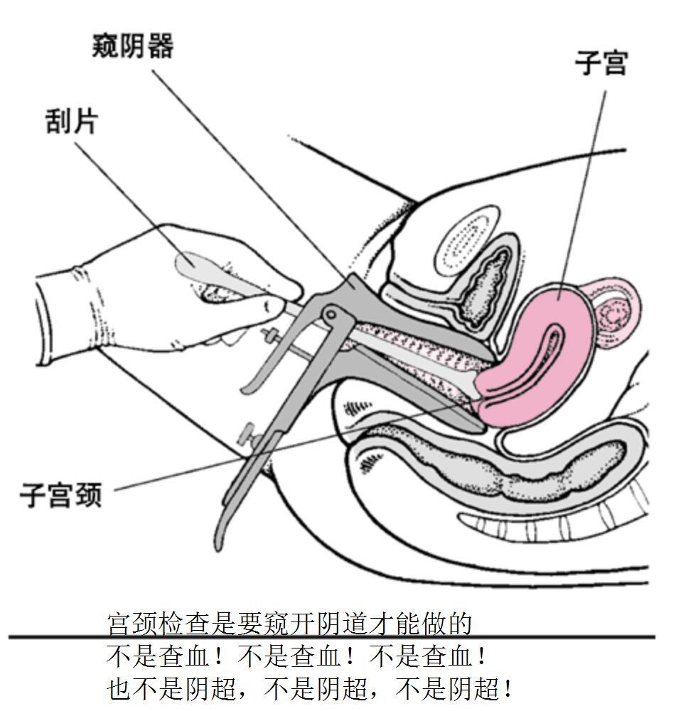 自己检查宫颈的方法图片