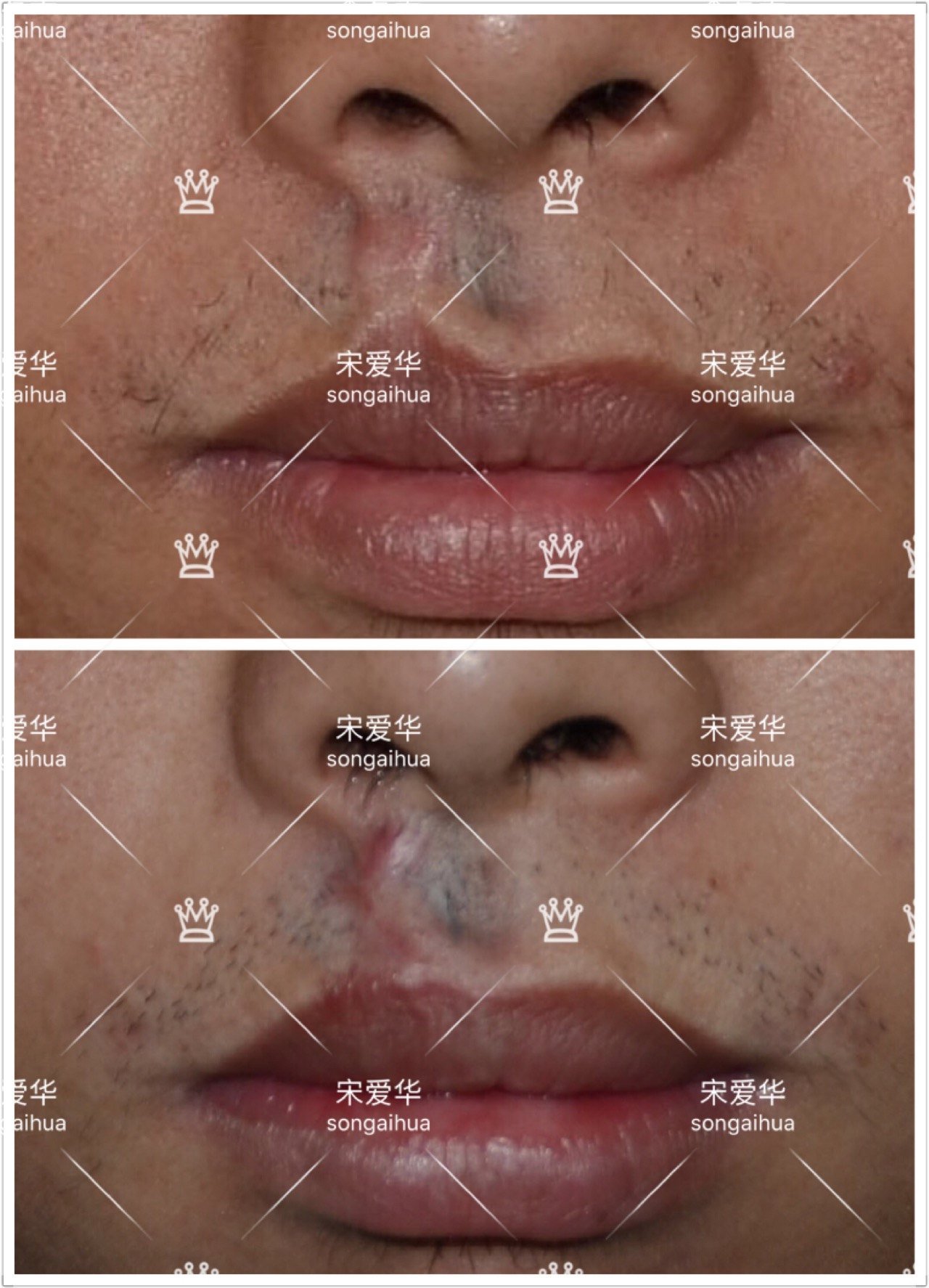 上唇疤痕牵拉畸形手术修复案例