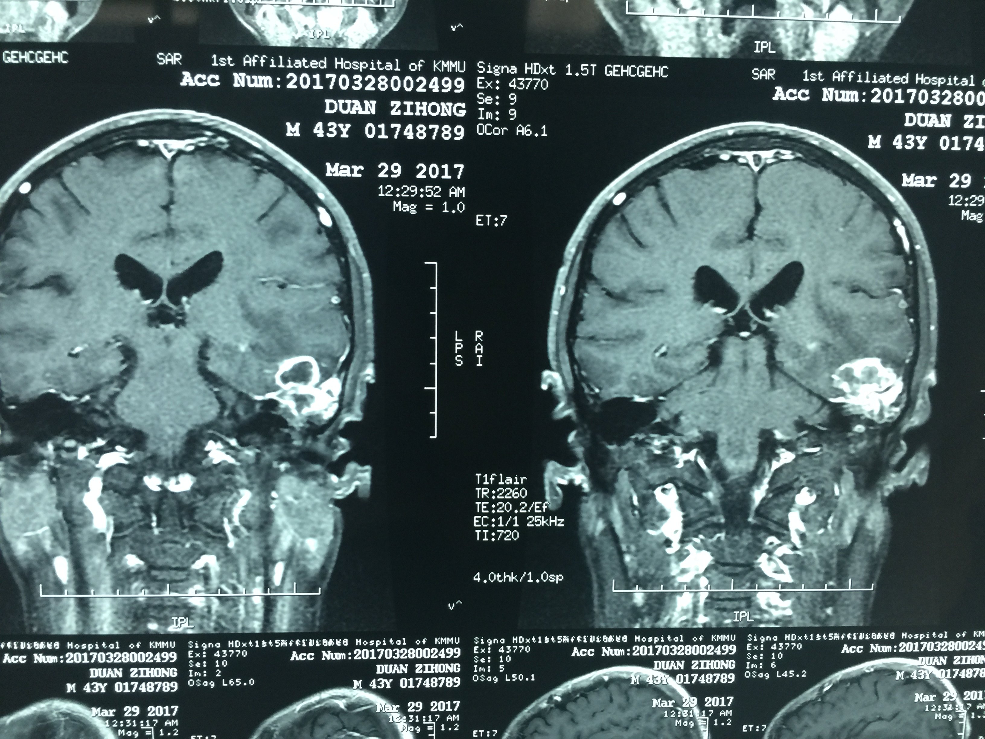 脑脓肿MRI图片
