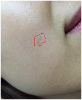 点痣后会留疤吗_疤痕_疾病介绍