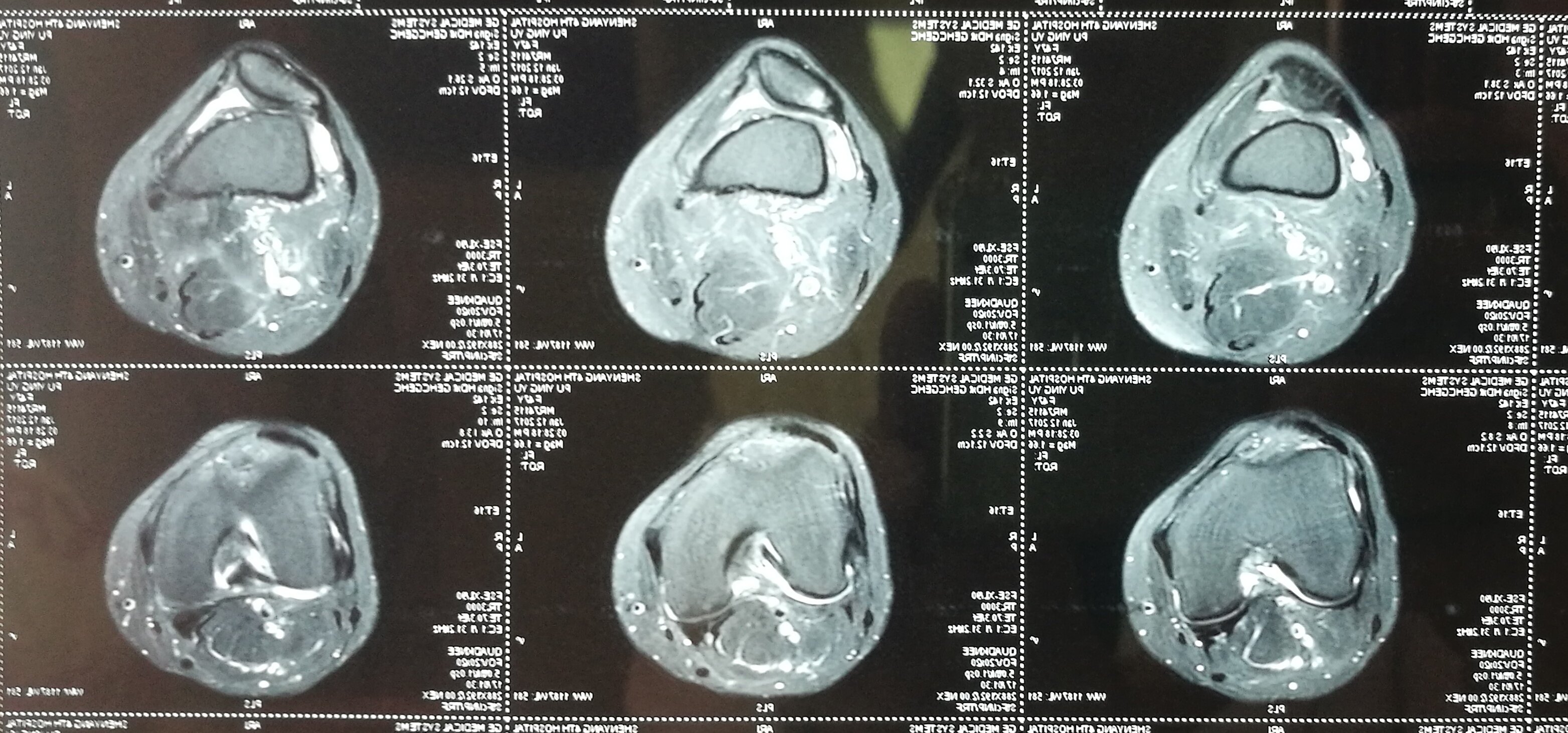 48歲女性膝關節高位髕骨髕股關節炎脛骨結節移位術