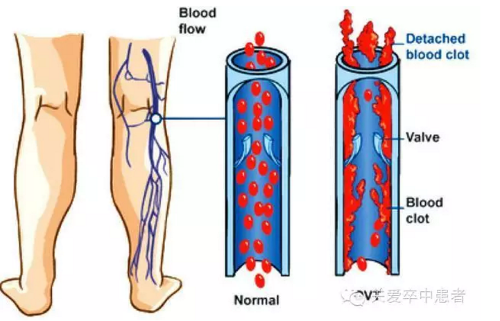 下肢深静脉血栓解剖图图片