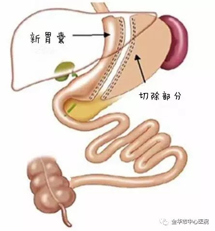胃缝合方法图解图片