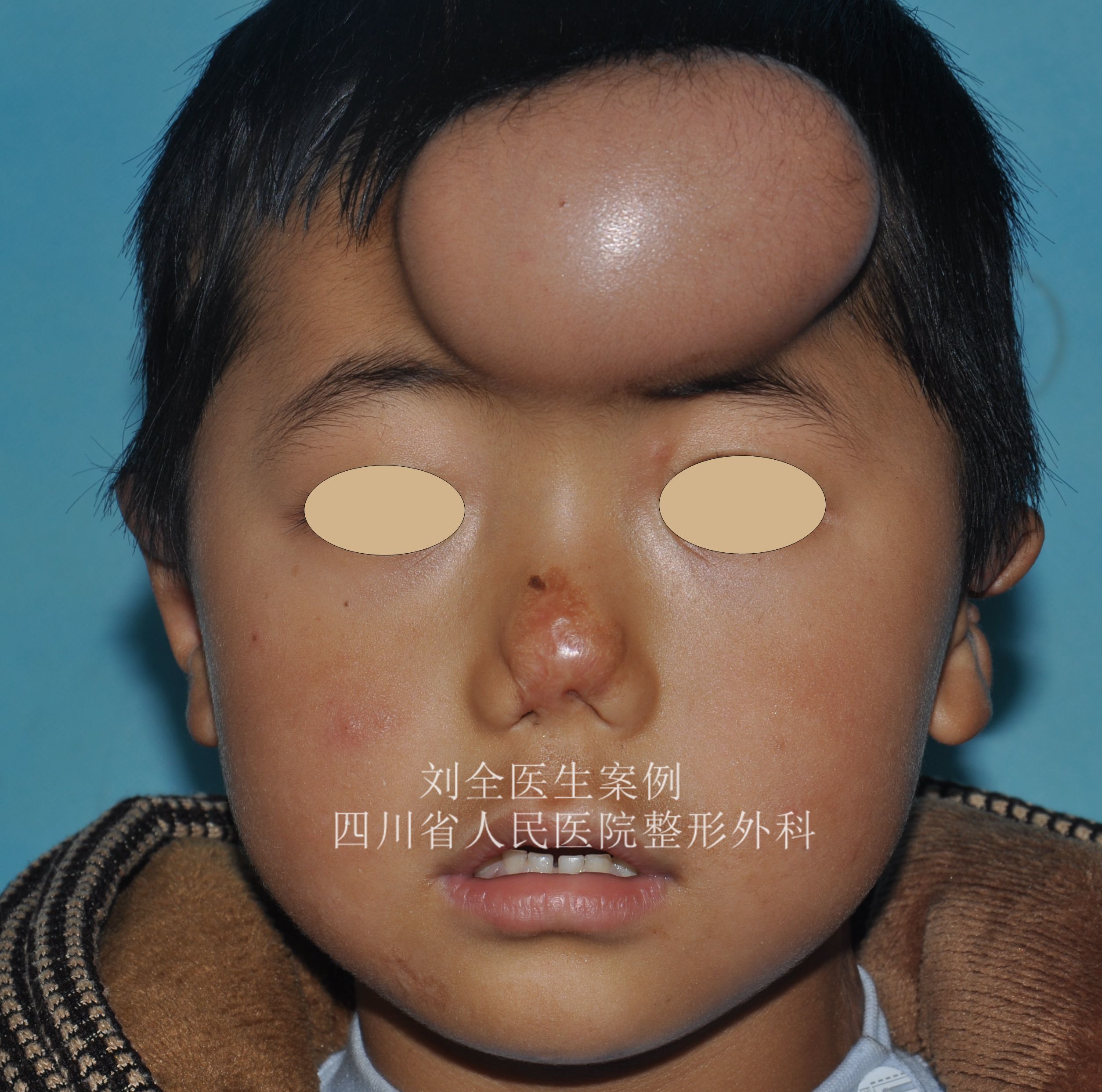 材料 来做一个新的鼻子了该图片可能引起不适继续查看经过几期的手术