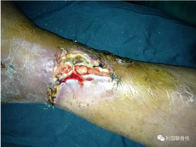 洛阳正骨陈利国大夫中医药治疗骨伤感染创面片段图片 - 好大夫在线