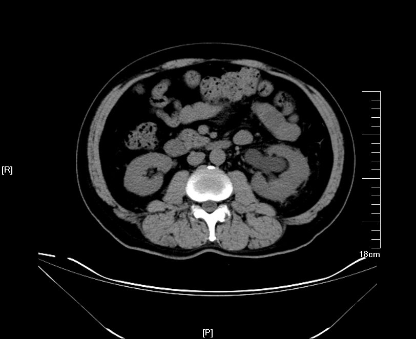 ct顯示先天性左重複腎y型輸尿管,左輸尿管結石,左腎結石;左腎周積液