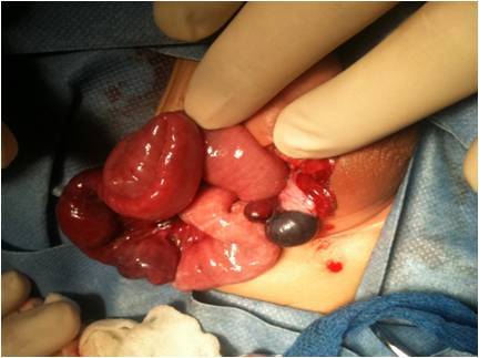 新生儿腹股沟斜疝嵌顿后果严重,腹腔镜使手术创伤极小化