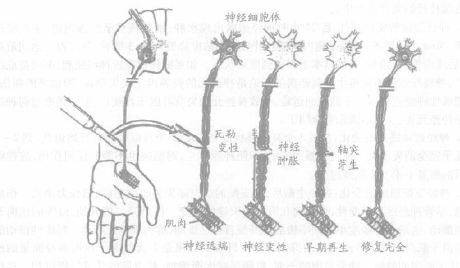 【神經損傷】外周神經損傷斷裂的手術治療