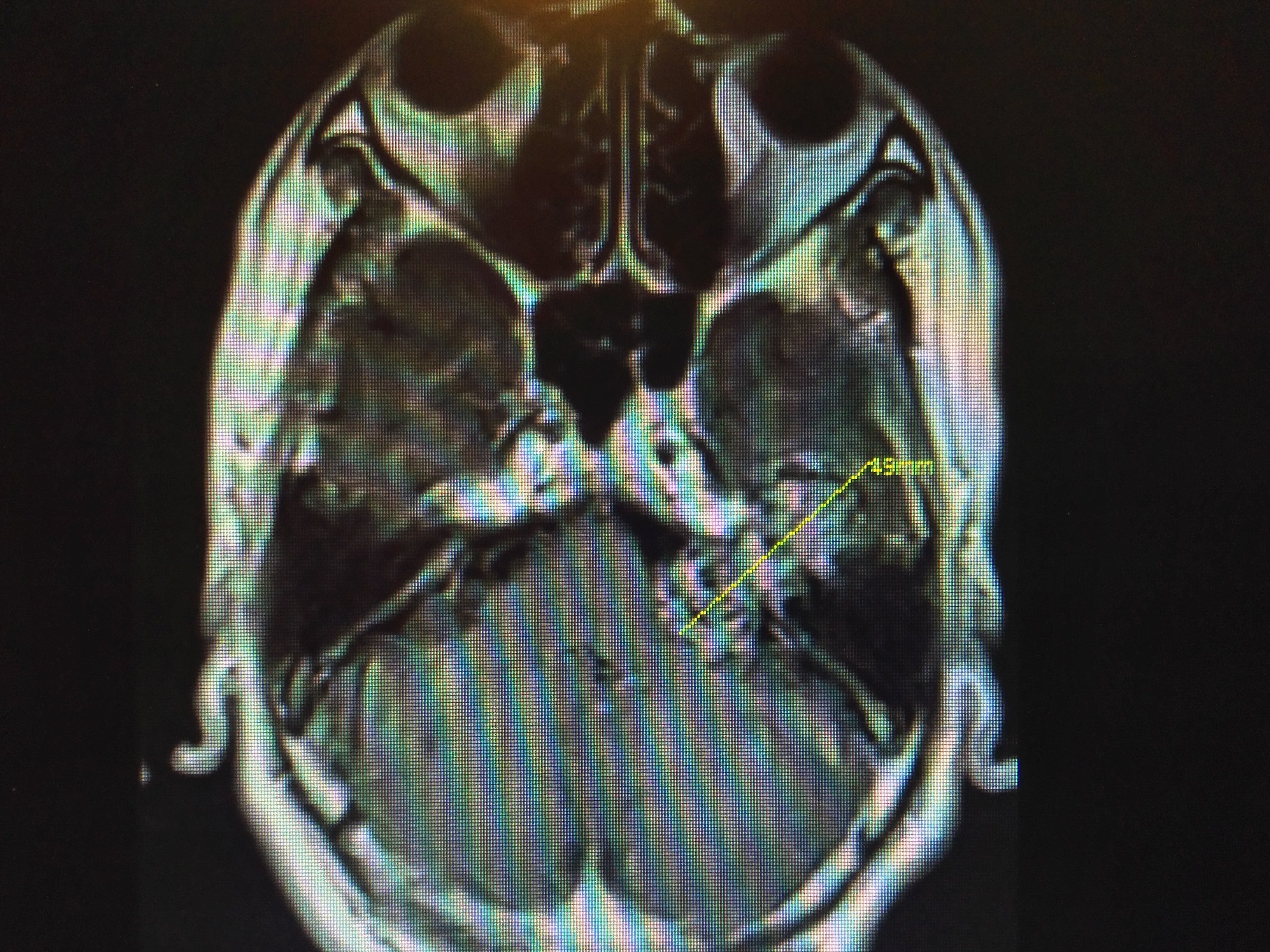 一组实质性听神经瘤全切,面神经全部解剖保留 - 好大夫在线
