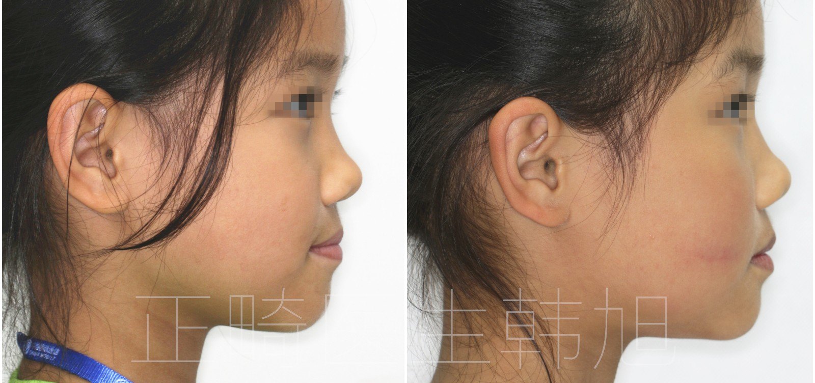 因舌位异常造成前牙开咬合,反咬合,利用生长发育