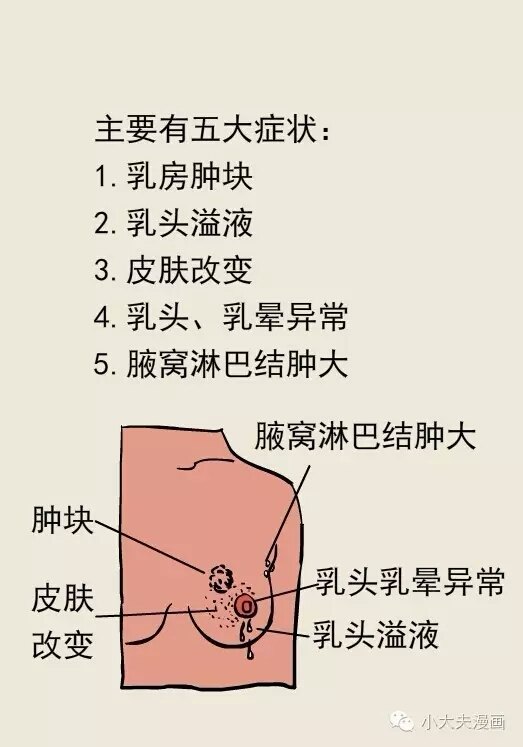 乳腺癌橘皮纹图片图片