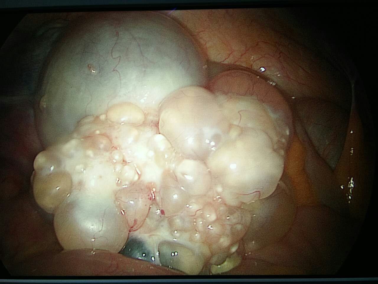 子宫左侧附件囊肿图片图片