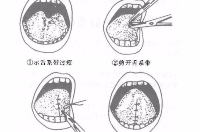 舌系带短压舌训练图解图片