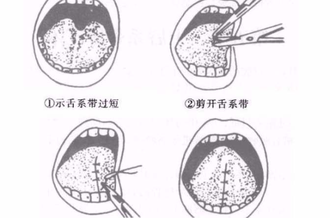 系带成形术示意图图片