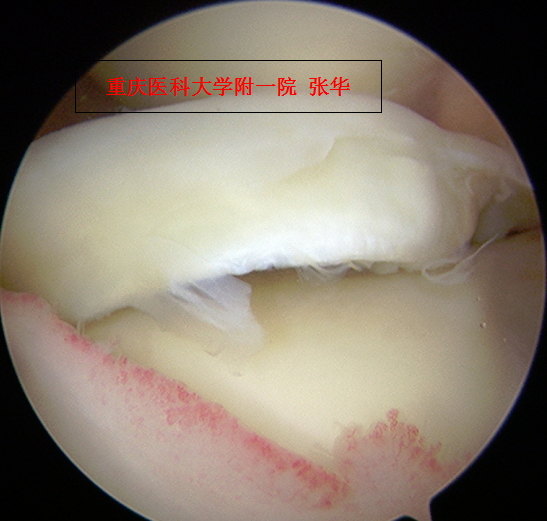 半月板桶柄样陈旧撕裂