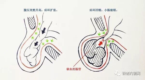 好大夫在线 张文兴 > 疝前疝后  而切口疝,造口疝主要表现为腹壁切口