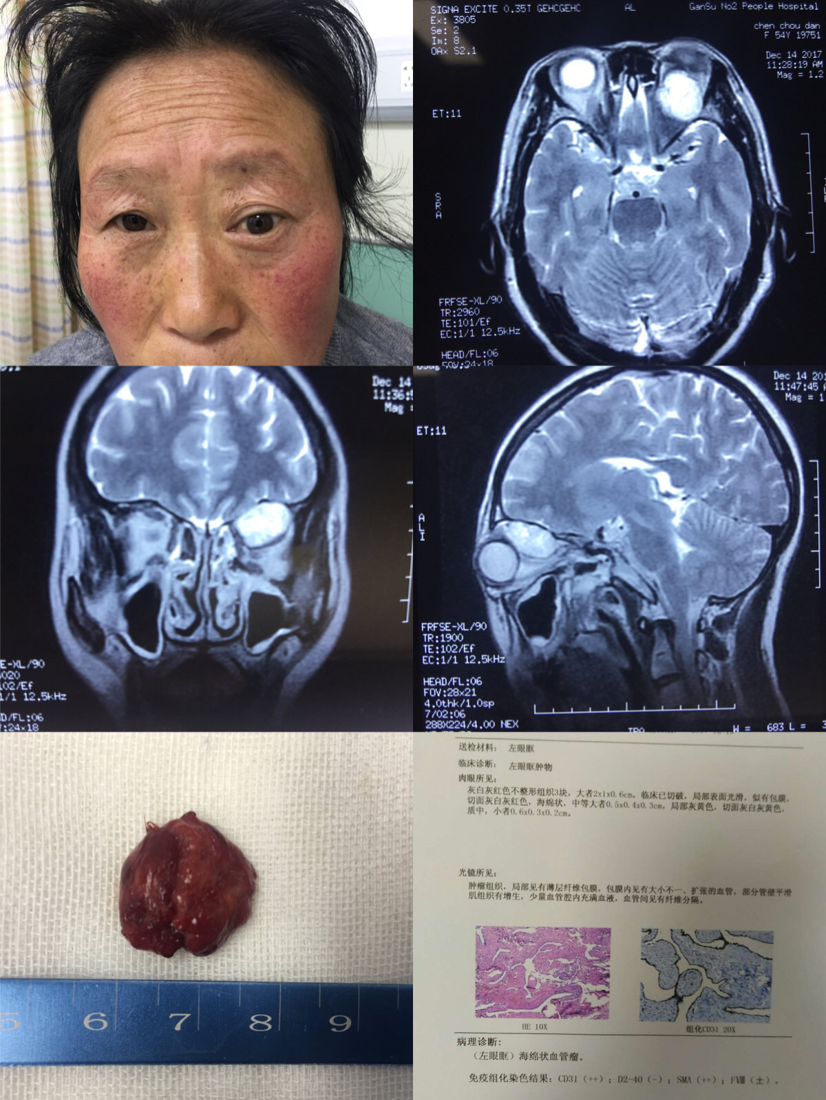 脑海绵状血管瘤10mm图片