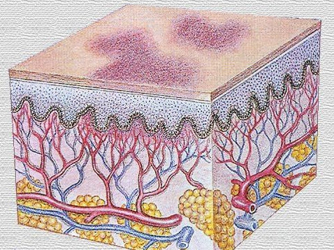 "红脸蛋"——面部毛细血管扩张激光治疗 (原创)