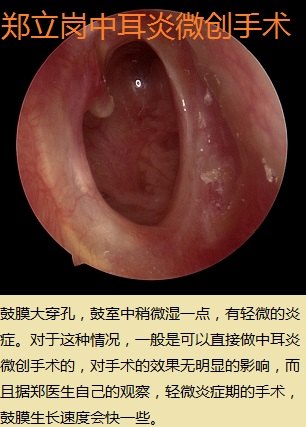 前言:中耳炎微創手術是目前治療慢性化膿性中耳炎及膽脂瘤型中耳炎最