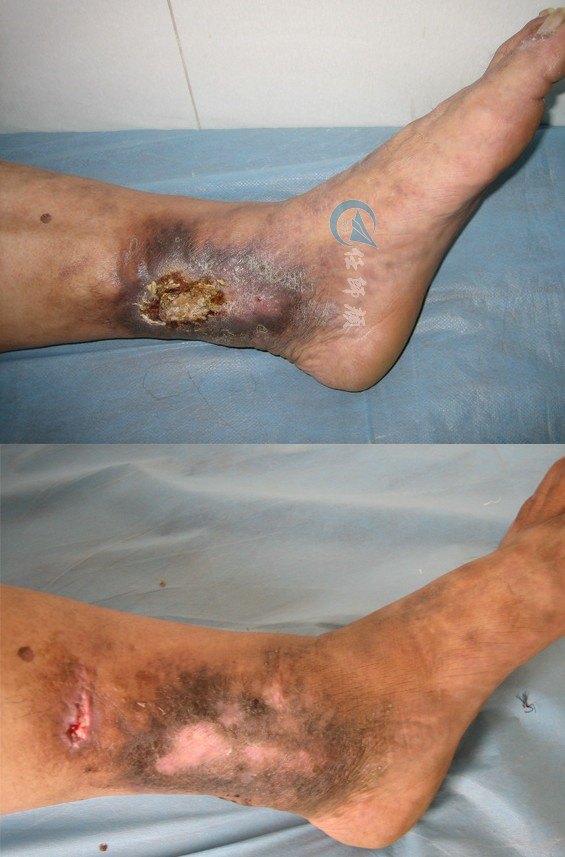 溃疡,老烂腿治疗前后图片