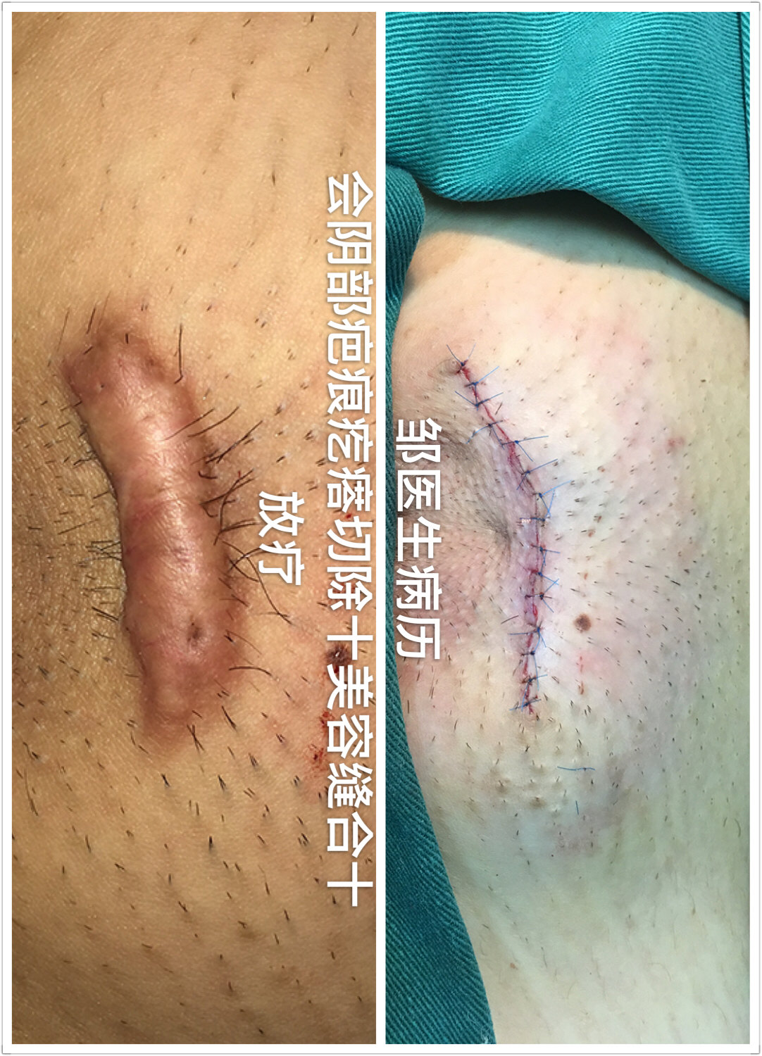 答:一般来说,疤痕疙瘩单纯手术切除后的复发率极高,我