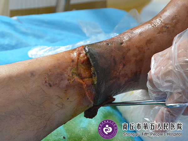 难愈合性创面修复:手术后伤口不愈合典型案例
