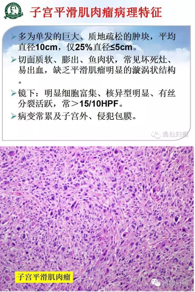 讲课| 子宫肉瘤诊治指南 - 好大夫在线