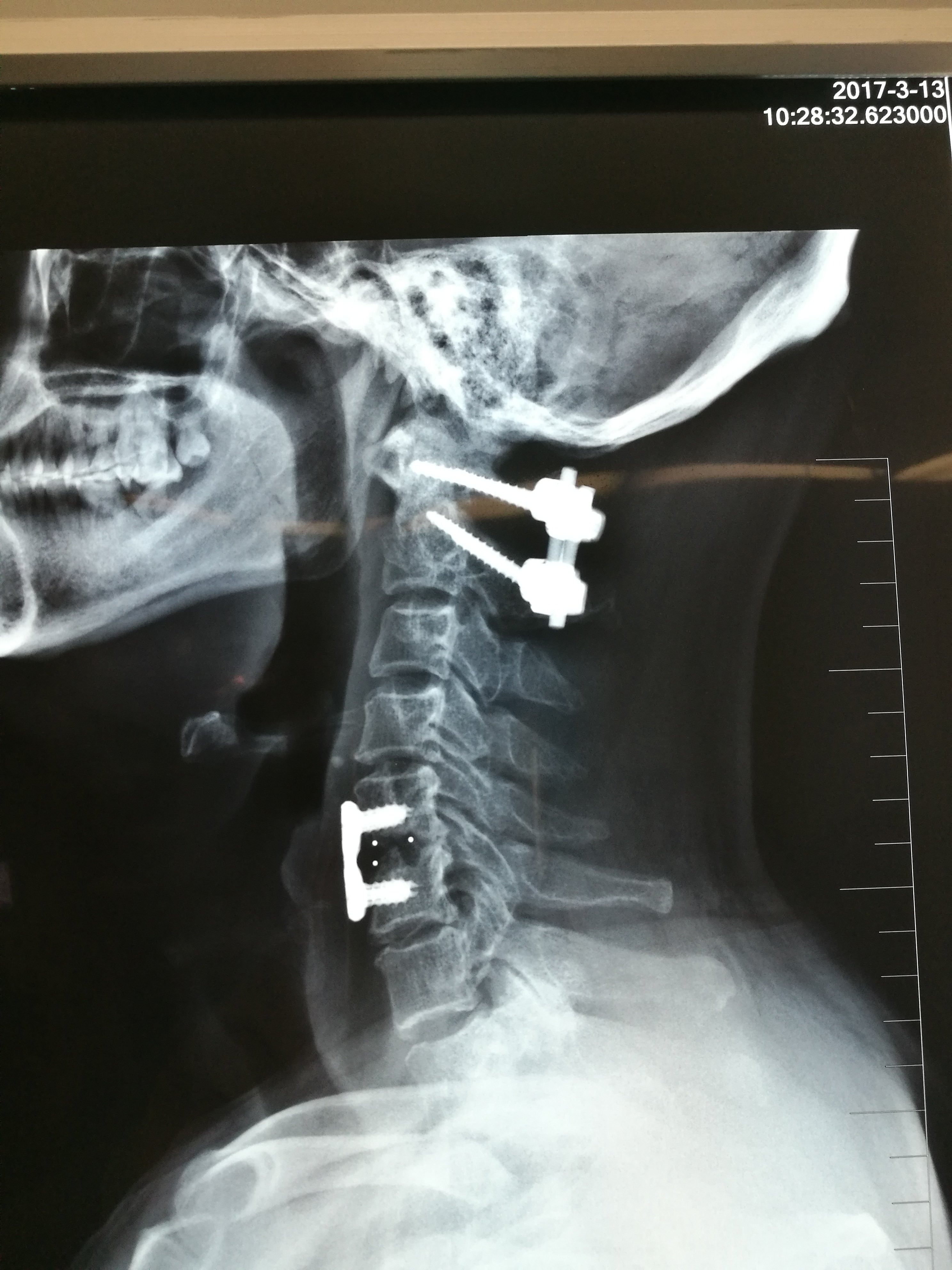 第2颈椎齿突骨折,颈间盘突出术后半年 
