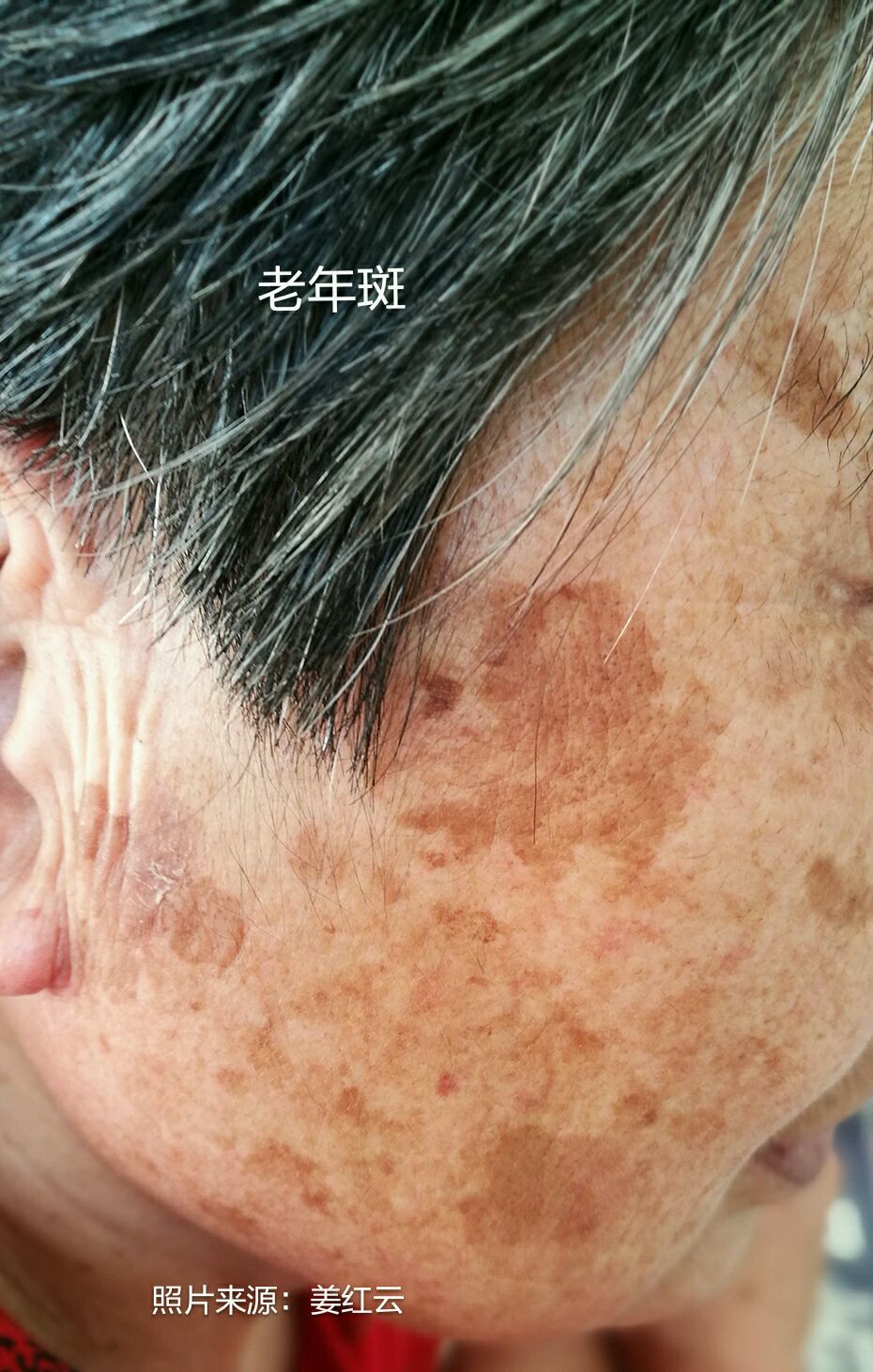 黄褐斑?老年斑?