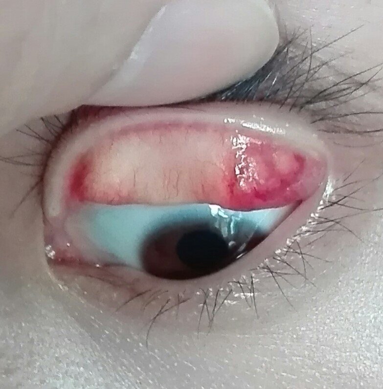 图解霰粒肿 - 好大夫在线