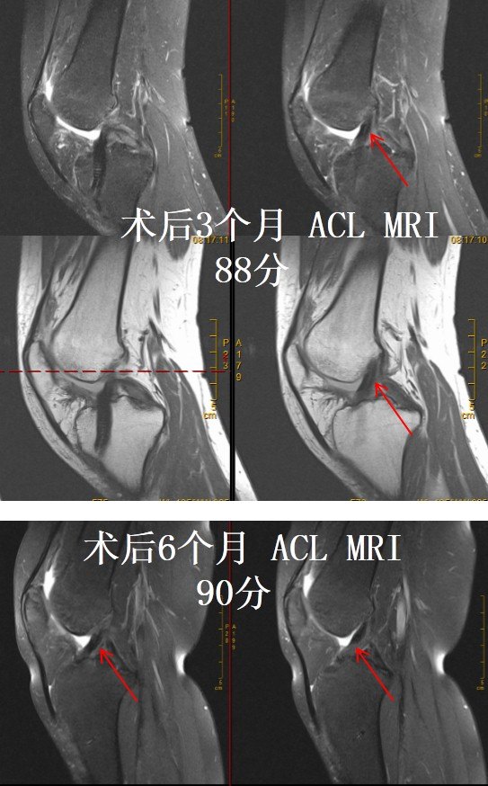 做完前交叉韧带 Acl 重建手术后韧带 变 啥样 好大夫在线