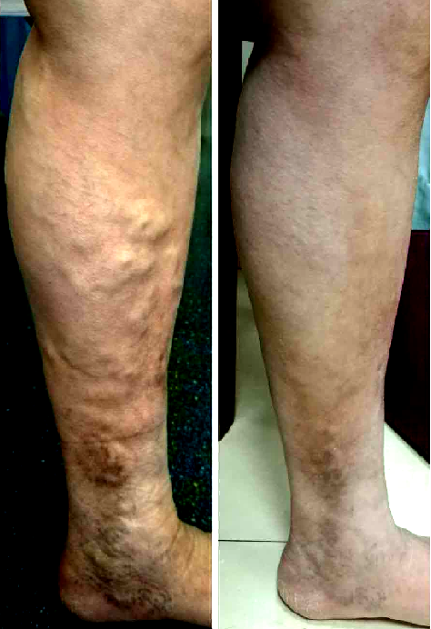 微创,美容,无痛,快速治愈静脉曲张 - 好大夫在线