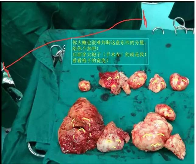 多发性子宫肌瘤切除这么大的子宫没一个伤口如何做到的
