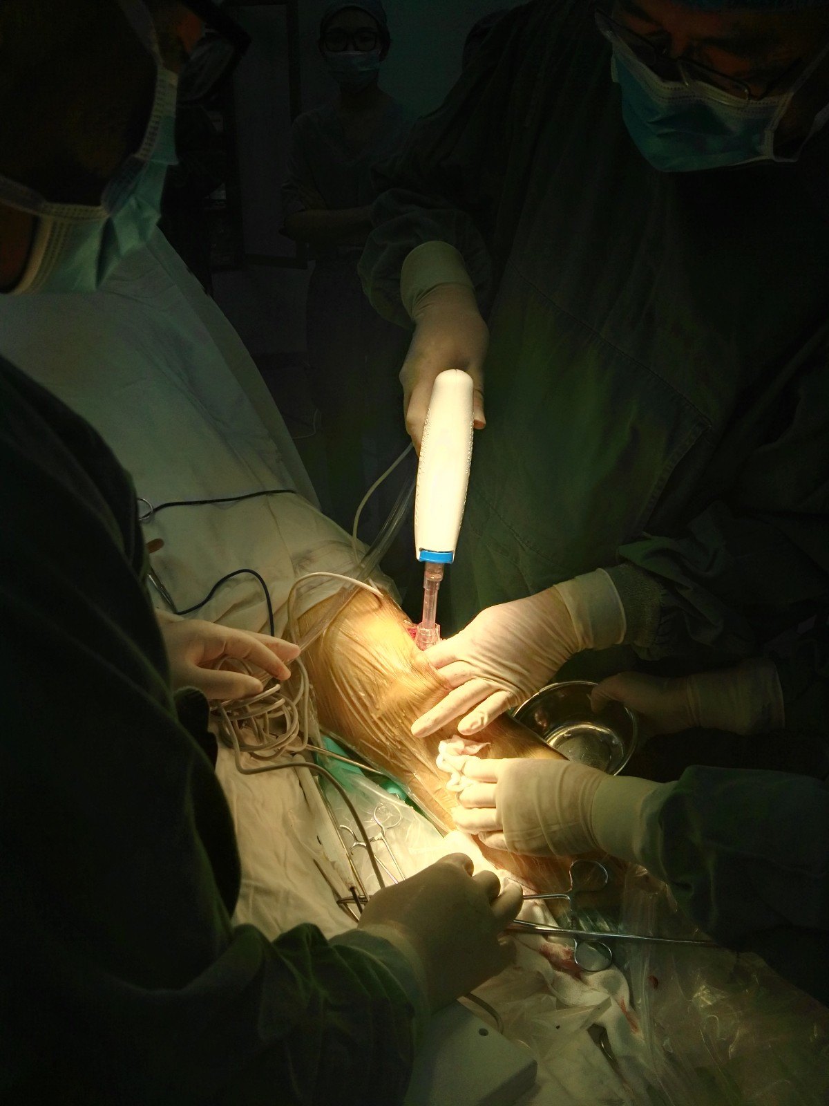 髌骨骨折的髌骨爪治疗