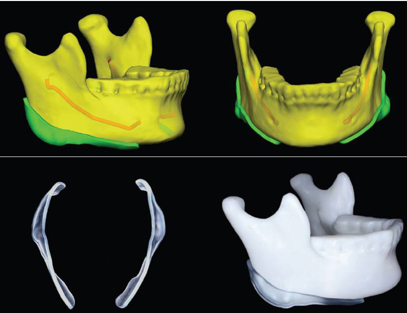 3D打印技术与面部轮廓整形(李运峰医生原创)