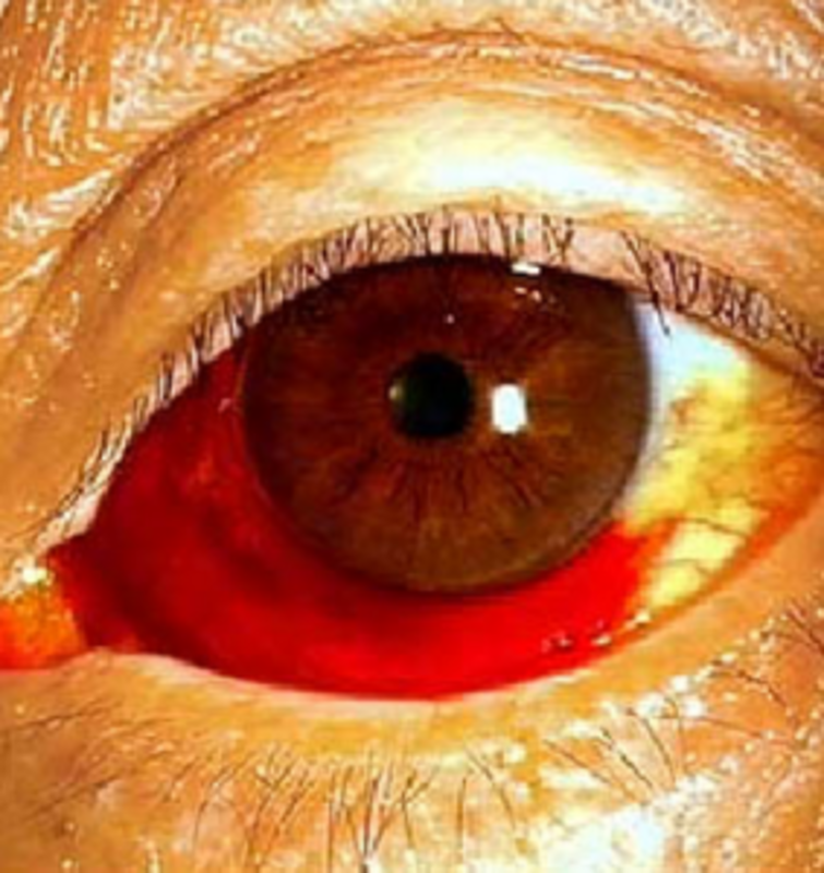 眼球毛细血管破裂图片