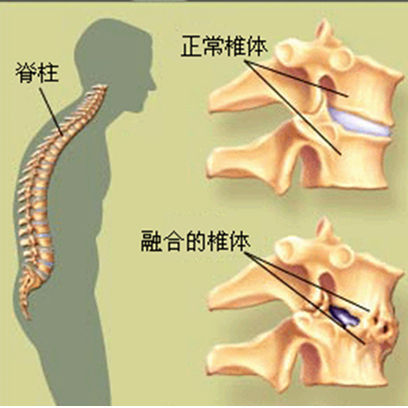 (科普)什麼是血清陰性脊柱關節病? - 好大夫在線