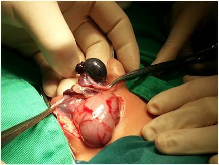 新生儿腹股沟斜疝嵌顿后果严重,腹腔镜使手术创伤极小化 