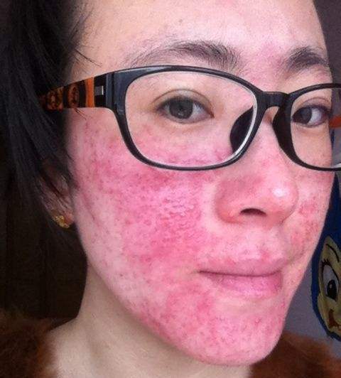 激素依赖性皮炎 面部.jpg